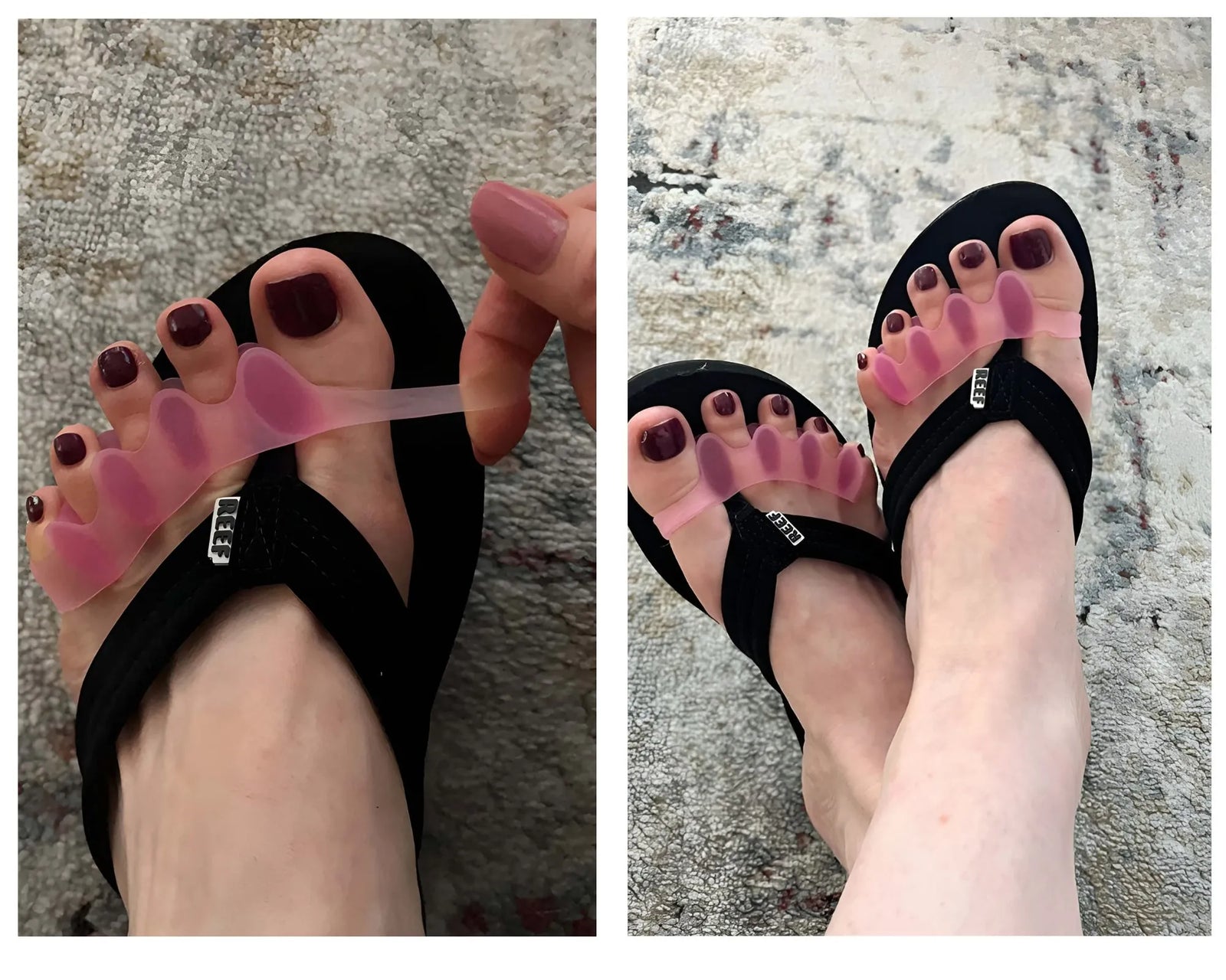 Visible Improvement That Not Only Realigns Toe's